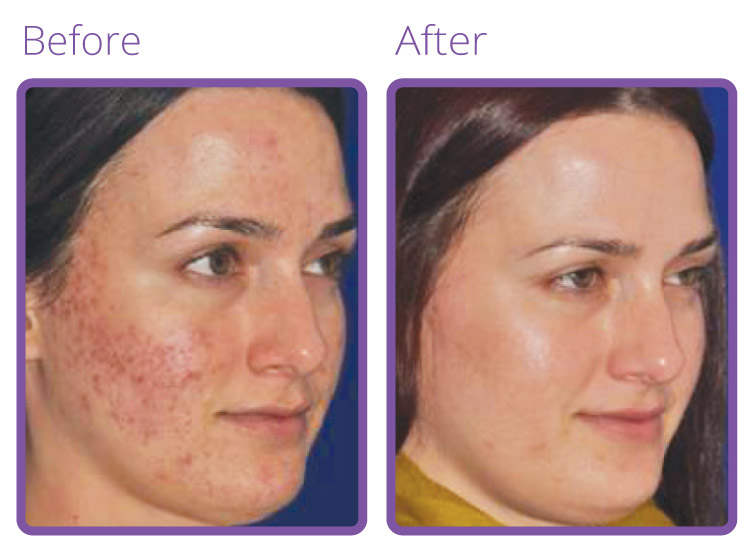 l-spa-micro-needling-before-after-2
