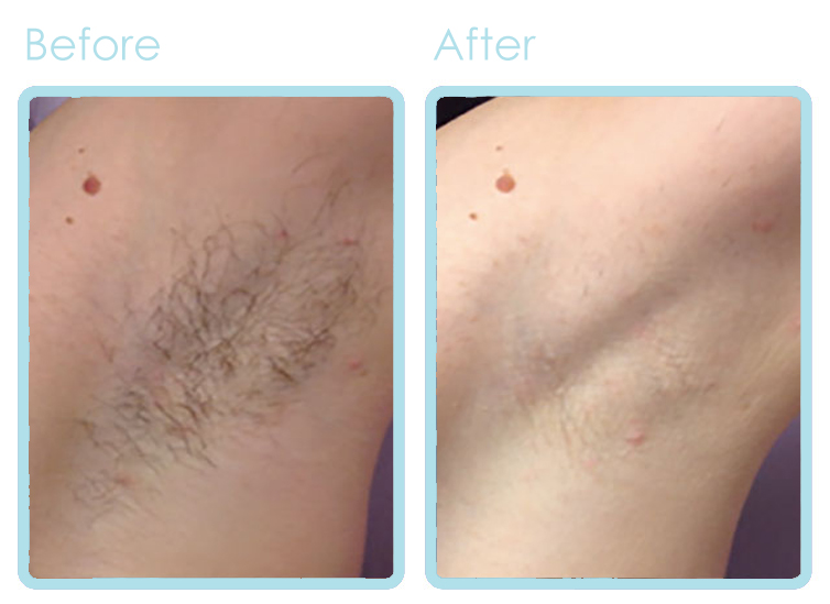 Hair Removal BEFORE-AFTER blue