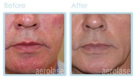 NEOSKIN Rosacea