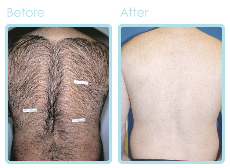 Hair Removal BEFORE-AFTER 2 blue